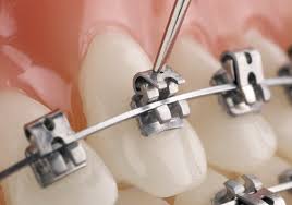 Orthodontics (Self-Ligating Brackets)